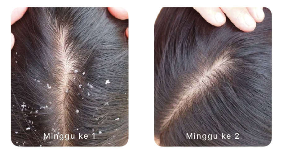 Ketombe Berkurang dalam 14 Hari