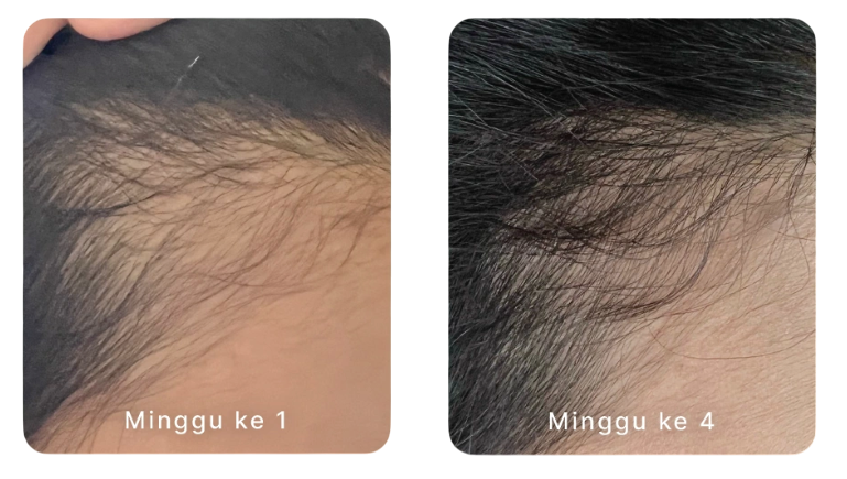 Rambut Rontok Berkurang dalam 4 Minggu